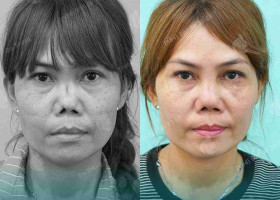 6 ưu và nhược điểm của nâng mũi trung bì mỡ – Copy