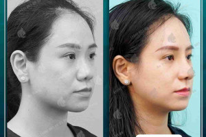 Điểm danh 6 ưu và nhược điểm của nâng mũi sụn sườn