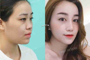 Có nên nâng mũi bây giờ để kịp đón Tết?