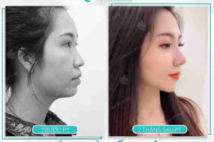 Nâng mũi cấu trúc có đắt không? Giá bao nhiêu?