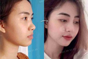 Nâng mũi có thay đổi khuôn mặt không? 