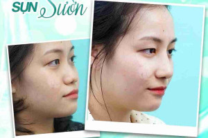 Nâng mũi sụn sườn giá bao nhiêu? Có đắt không?