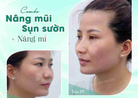 Có nên vừa nâng mũi, vừa cắt mí không?