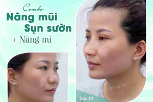 Có nên vừa nâng mũi, vừa cắt mí không?