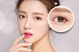 Quy trình 8 bước cắt mí bác sĩ Trang: Đẹp và An toàn