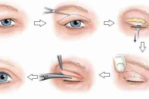 Bác sĩ Trang giải đáp: Cắt mí kiêng ăn gì