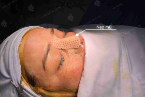 6 cách làm tan máu bầm sau nâng mũi nhanh chóng, hiệu quả