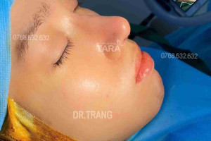 3 lưu ý quan trọng khi nâng mũi sau 10 ngày