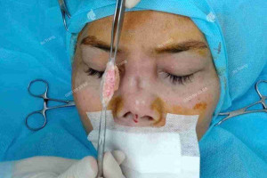 Nâng mũi trung bì mỡ giá bao nhiêu? Có đắt không?