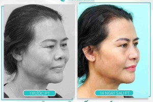 U50 có nên nâng mũi không? Mũi có đẹp không?