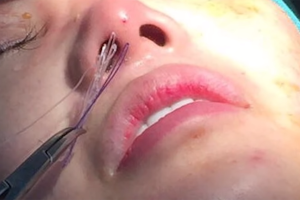 Làm gì khi vết khâu nâng mũi có mủ? Có nguy hiểm không?