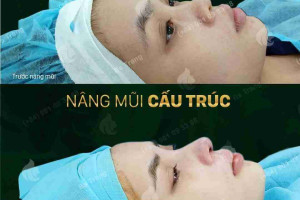 Nâng mũi bằng sụn tai có tốt không và lưu ý khi nâng mũi