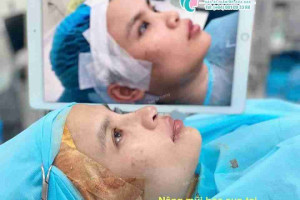 Nâng mũi bọc sụn là gì? Ai nên nâng mũi bọc sụn?