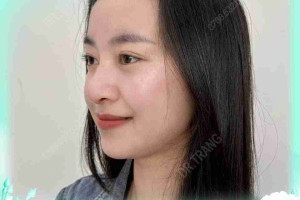 Bác sĩ giải đáp: Nâng mũi sụn tự thân có teo không?