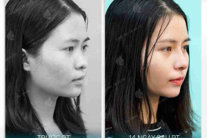 Nâng mũi sau bao lâu thì đi làm được và lời khuyên của bác sĩ