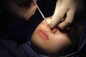 Tháo sụn mũi đã nâng có đau không? Lưu ý khi thực hiện