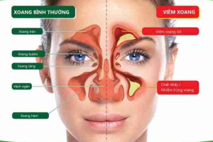 Bác sĩ giải đáp: bị viêm xoang có được nâng mũi không?