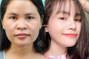 Nâng mũi 3 ngày vào form xong có được vận động mạnh không?