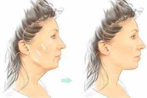 Căng da Midface bao lâu thì vết thương lành?