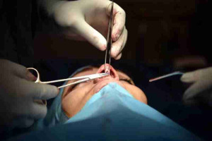 Loại bỏ sụn nhân tạo sau nâng mũi có đau không?