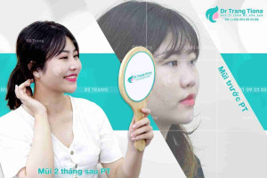 Bác sĩ trả lời: Nâng mũi cấu trúc bao lâu thì hết đau sưng đỏ?