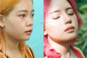 Nâng mũi xong có để lại di chứng về sau không?