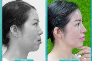 Nên niềng răng trước hay sau khi nâng mũi?