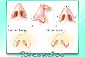 Phẫu thuật cắt cánh mũi là gì? Thực hiện như thế nào?