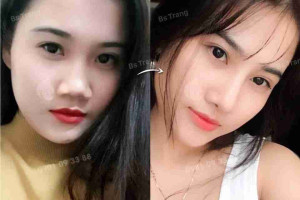 Phẫu thuật sửa mũi hếch như thế nào? Có đắt không?