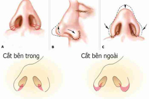 Bác sĩ giải đáp: Thu gọn cánh mũi có bị sưng đau không?