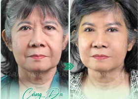 Bí quyết phẫu thuật căng da mặt đẹp nhất 2024