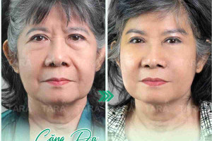 Bí quyết phẫu thuật căng da mặt đẹp nhất 2024