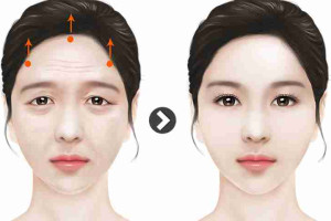 Bác sĩ giải đáp: Căng da mặt có phải gây mê không?