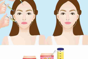 Bác sĩ giải đáp: Cấy mỡ mặt Babyface có đau không? 