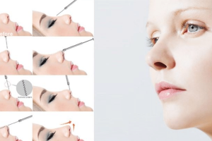 Nâng mũi bằng chỉ là gì? Có nên nâng mũi bằng chỉ không?