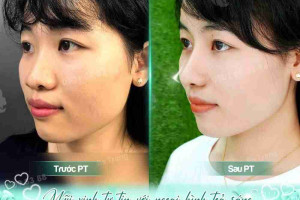 Bác sĩ giải đáp: Nâng mũi sau một tháng đã lành và đẹp chưa?