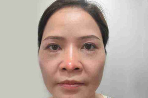 Tại sao đầu mũi bị bóng đỏ sau nâng mũi? Có nguy hiểm không?