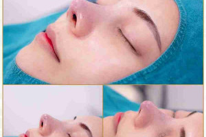 Tại sao mũi bị lộ sóng sau nâng mũi? Cách khắc phục