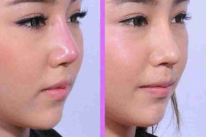 Bác sĩ giải đáp: Bị lộ sóng mũi sau nâng phải làm gì?