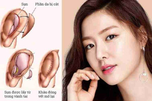 Có được sử dụng sụn tai của người thân để nâng mũi không?