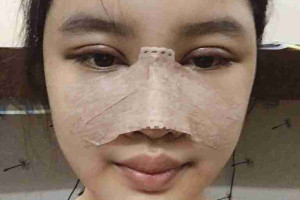 4 dấu hiệu nhận biết mũi bị biến chứng sau nâng mũi 