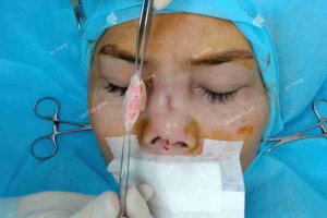 Có được sử dụng trung bì mỡ của người khác để nâng mũi không?