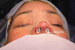 Vết khâu nâng mũi bị chảy dịch rỉ máu kéo dài có nguy hiểm không?