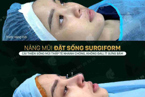 Cụ thể về các bước hồi phục sau khi nâng mũi Sline