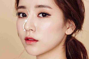 Giải đáp từ A-Z về nâng mũi Sline và lưu ý quan trọng