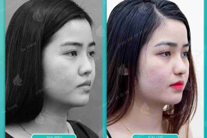 Tất tần tật về kinh nghiệm nâng mũi Sline dành cho người mới