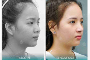 Sau khi nâng mũi nên làm gì để đạt được hiệu quả tốt nhất?