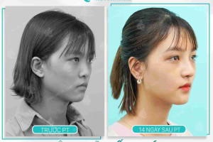 Đầu mũi bao lâu hết cứng sau nâng mũi?