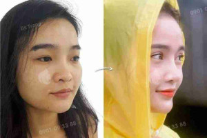 3 điều ít người biết về nâng mũi Sline