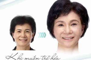 Bác sĩ giải đáp: Căng da thái dương có nguy hiểm không?